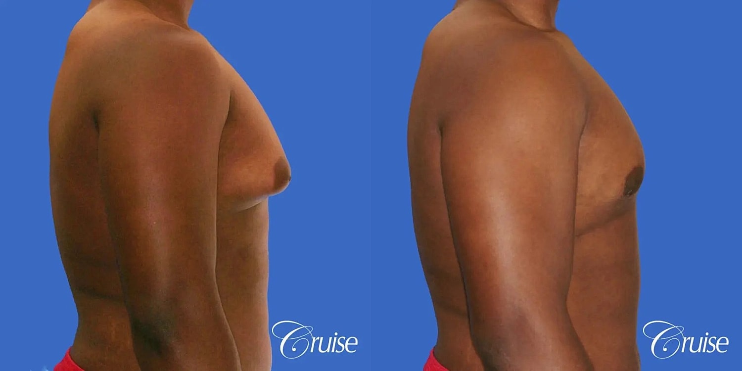 Gynecomastia Before & After