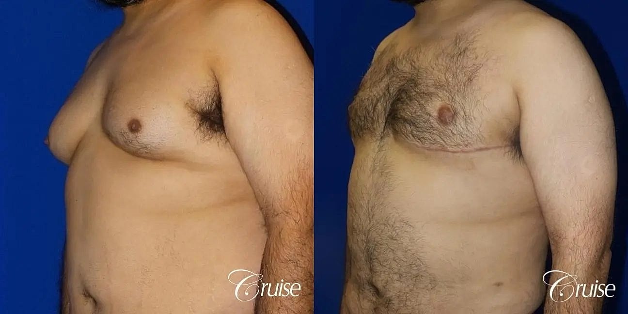 Gynecomastia Before & After