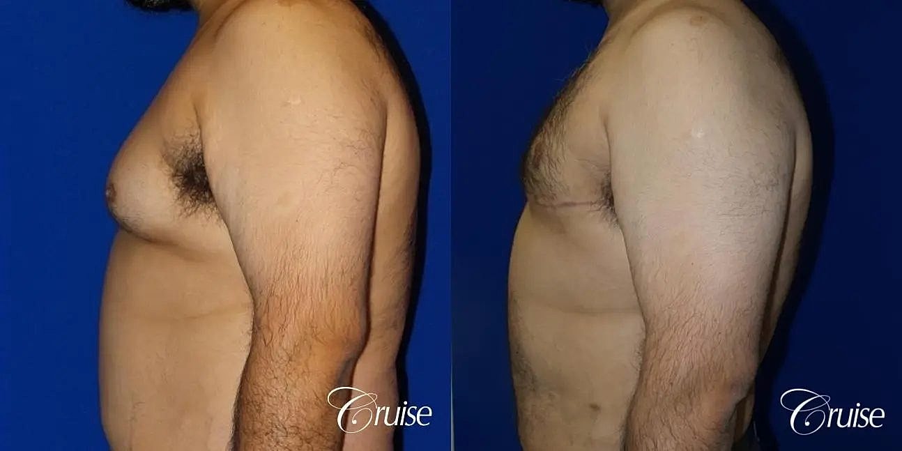 Gynecomastia Before & After
