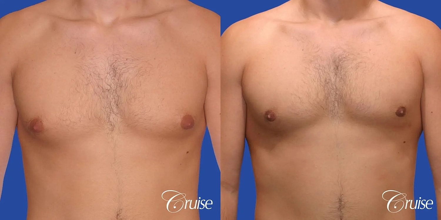 Gynecomastia Before & After