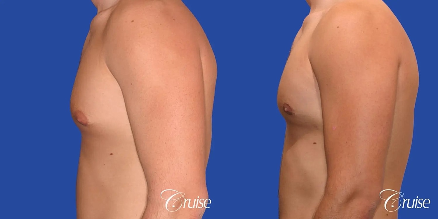 Gynecomastia Before & After