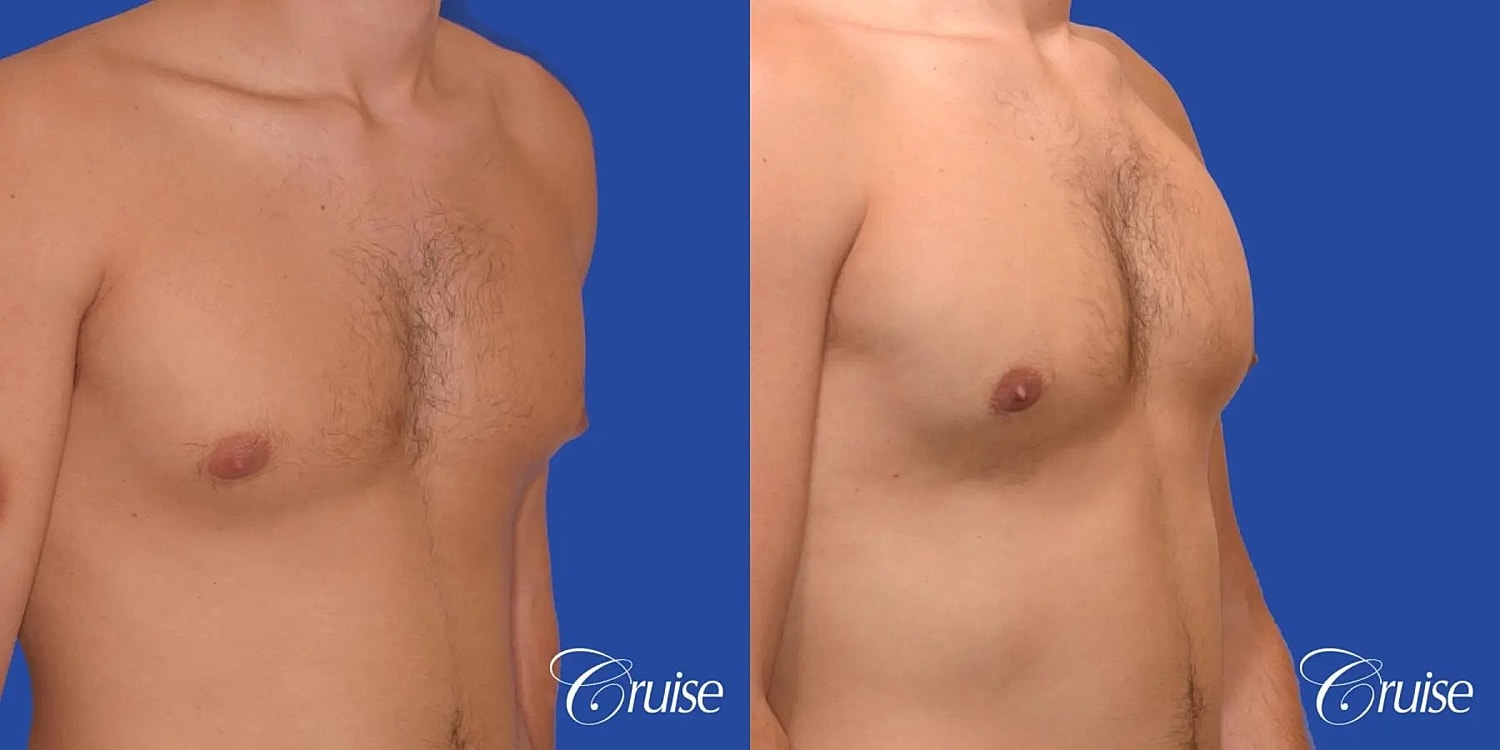 Gynecomastia Before & After