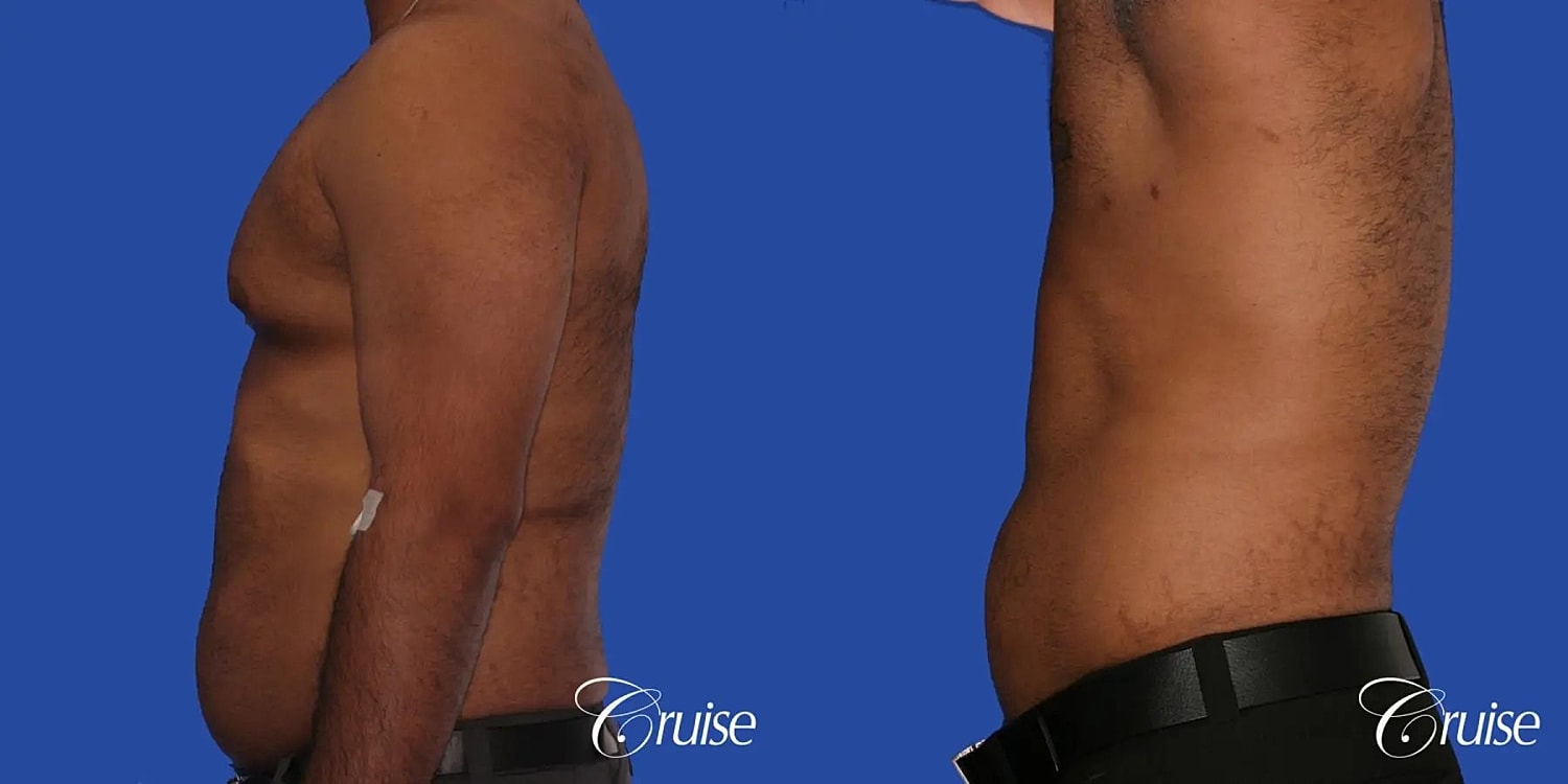 Gynecomastia Before & After