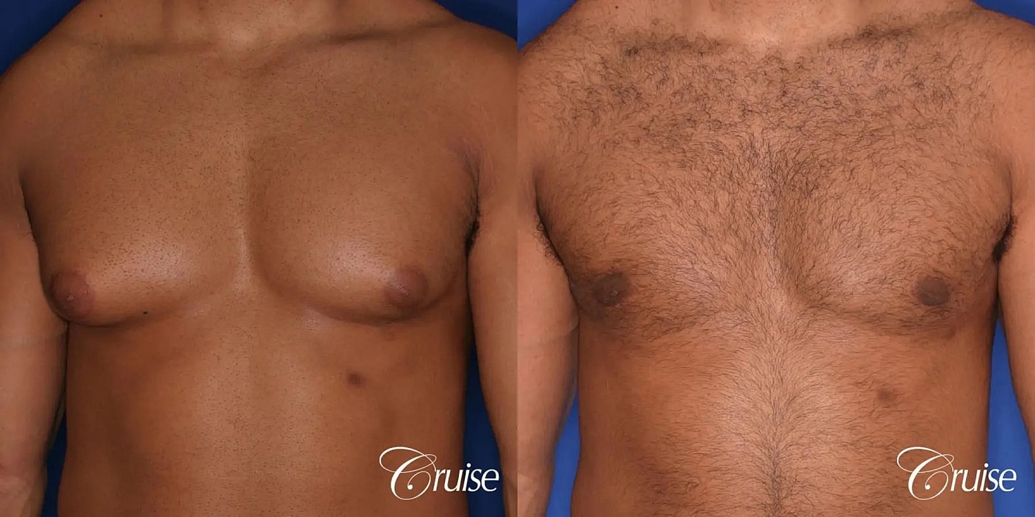 Gynecomastia Before & After