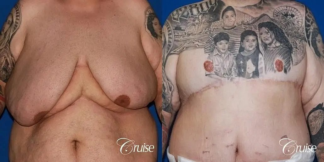 Gynecomastia Before & After