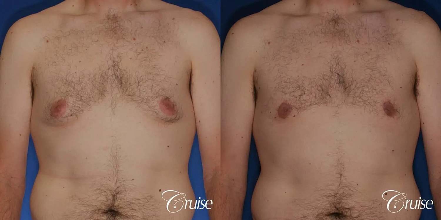 Gynecomastia Before & After