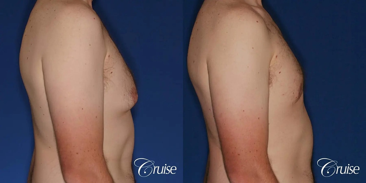 Gynecomastia Before & After
