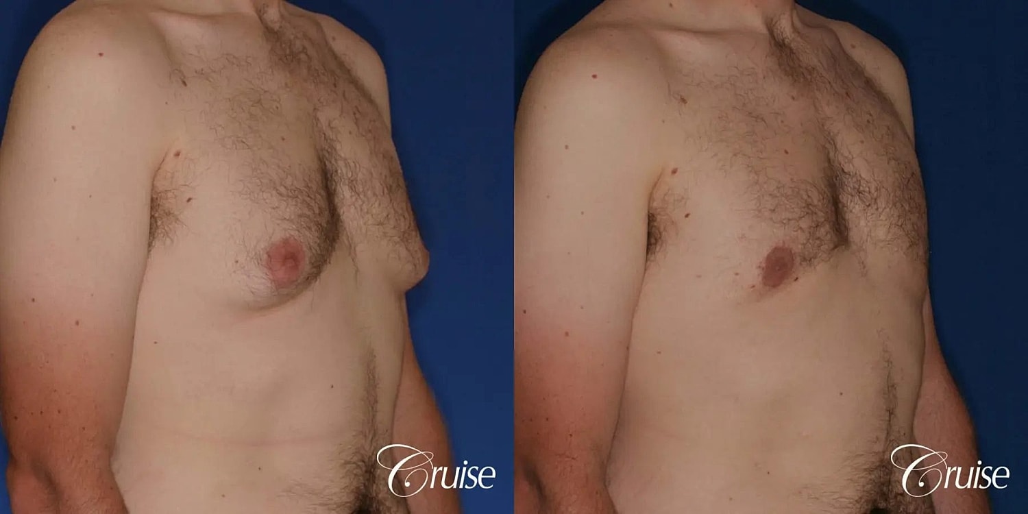 Gynecomastia Before & After