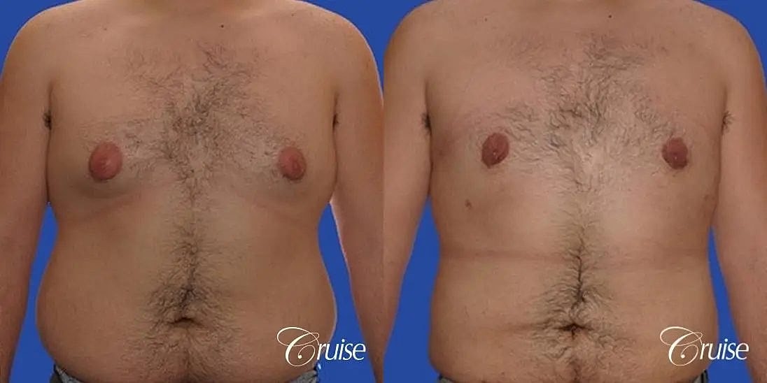 Gynecomastia Before & After