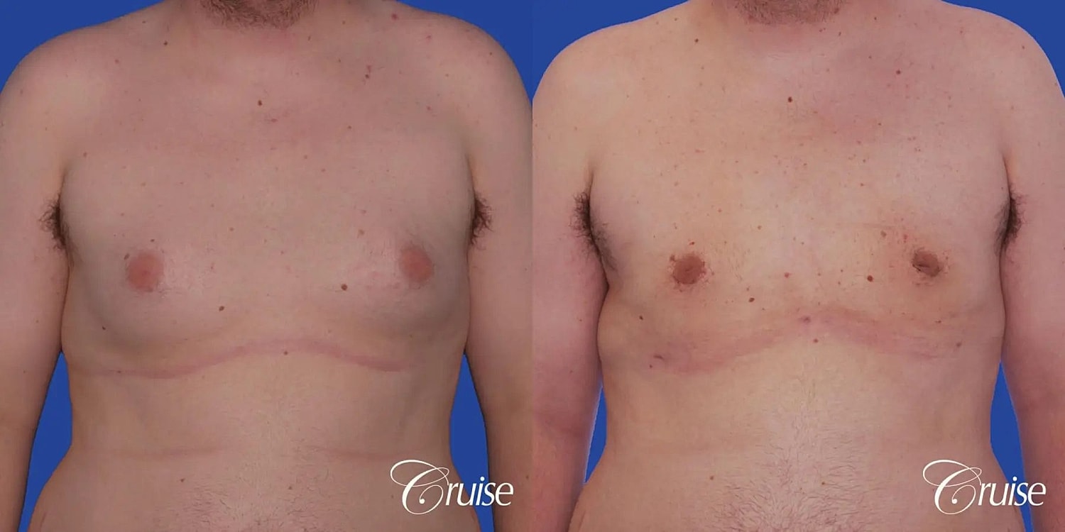Gynecomastia Before & After