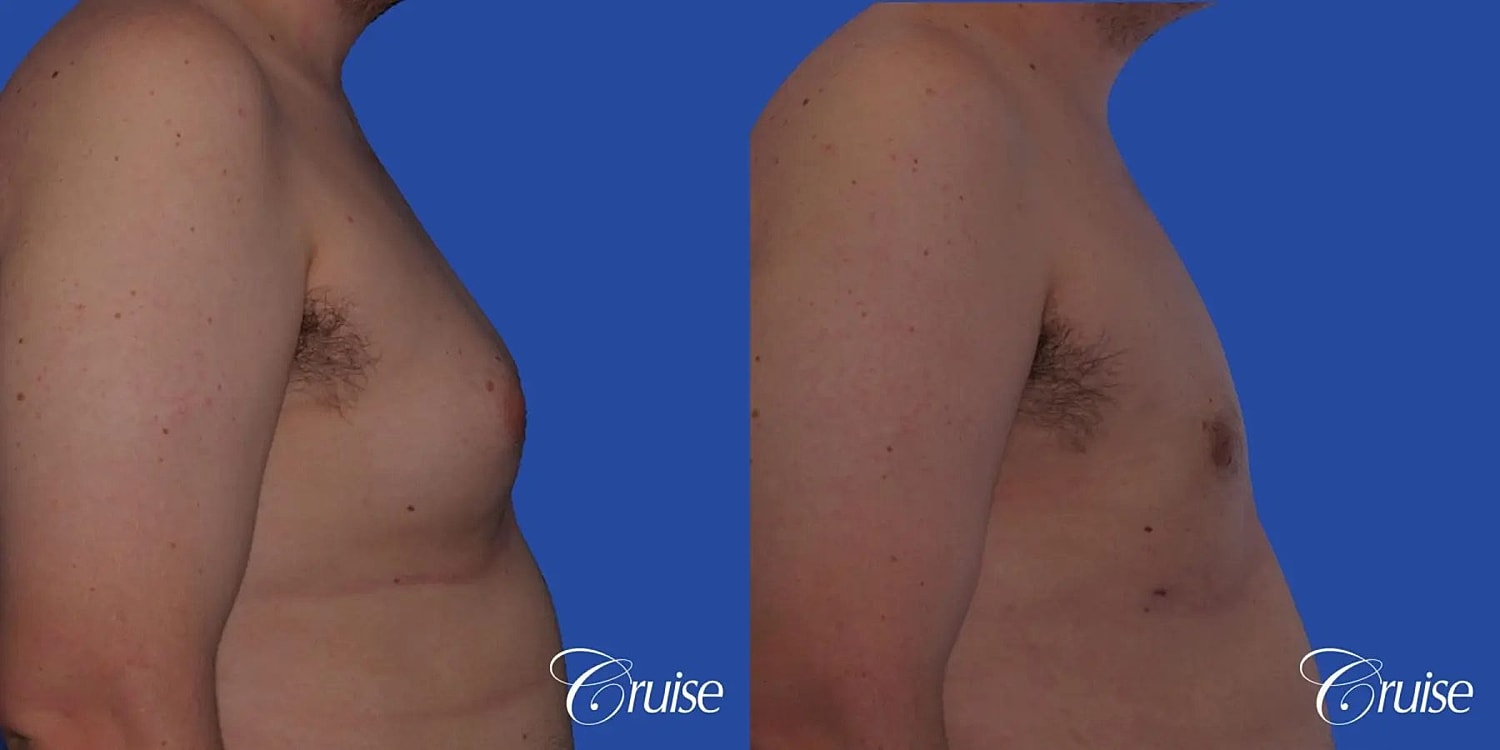 Gynecomastia Before & After
