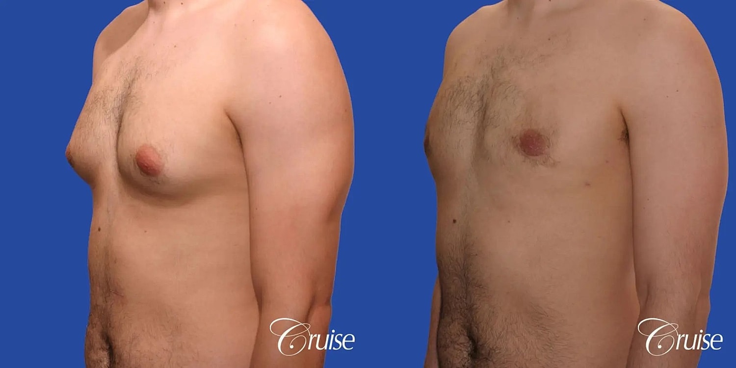 Gynecomastia Before & After