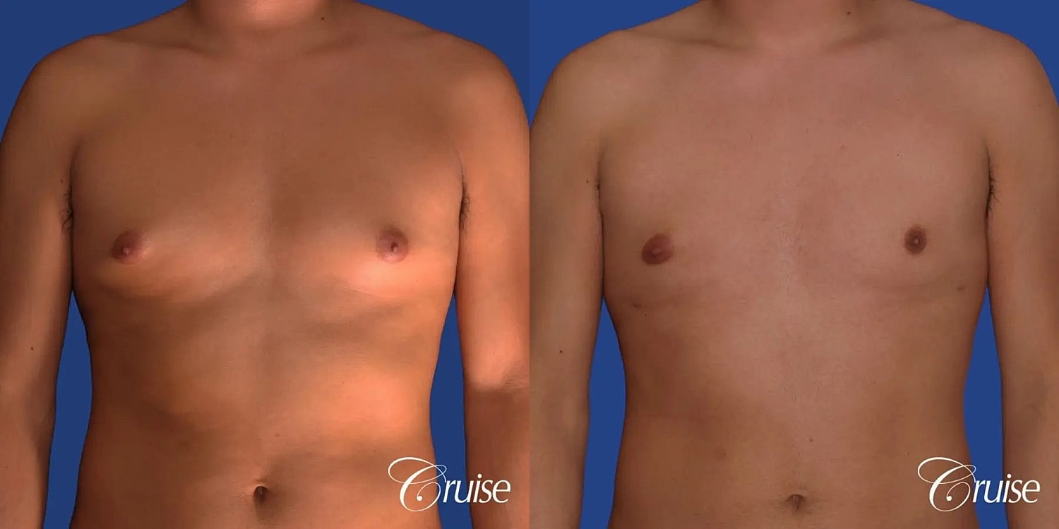 Gynecomastia Before & After