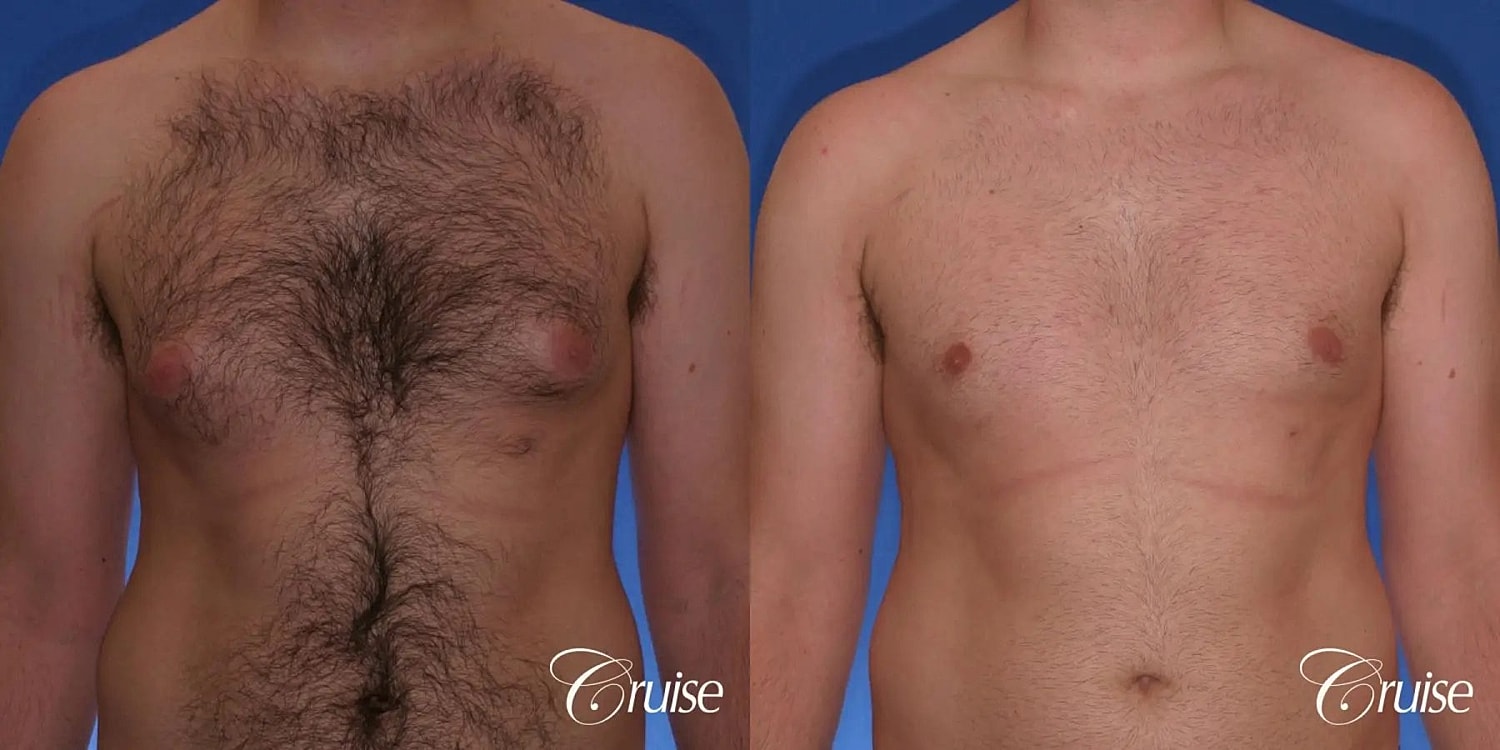 Gynecomastia Before & After