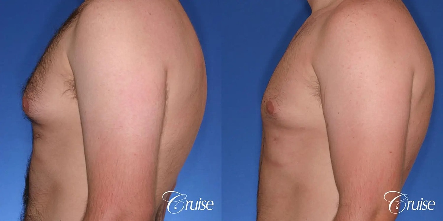 Gynecomastia Before & After