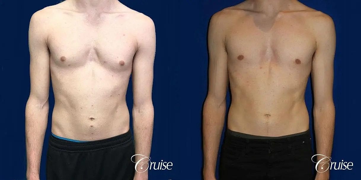 Gynecomastia Before & After