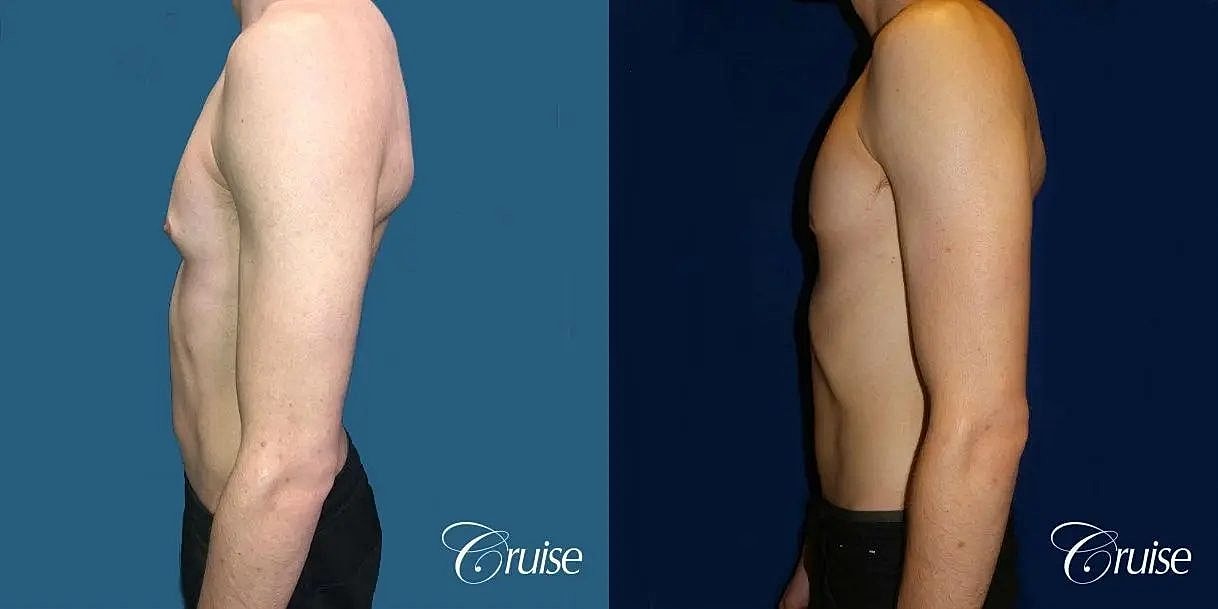 Gynecomastia Before & After