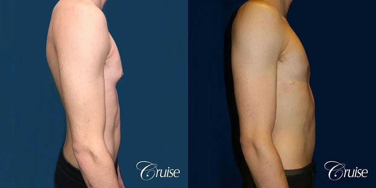 Gynecomastia Before & After