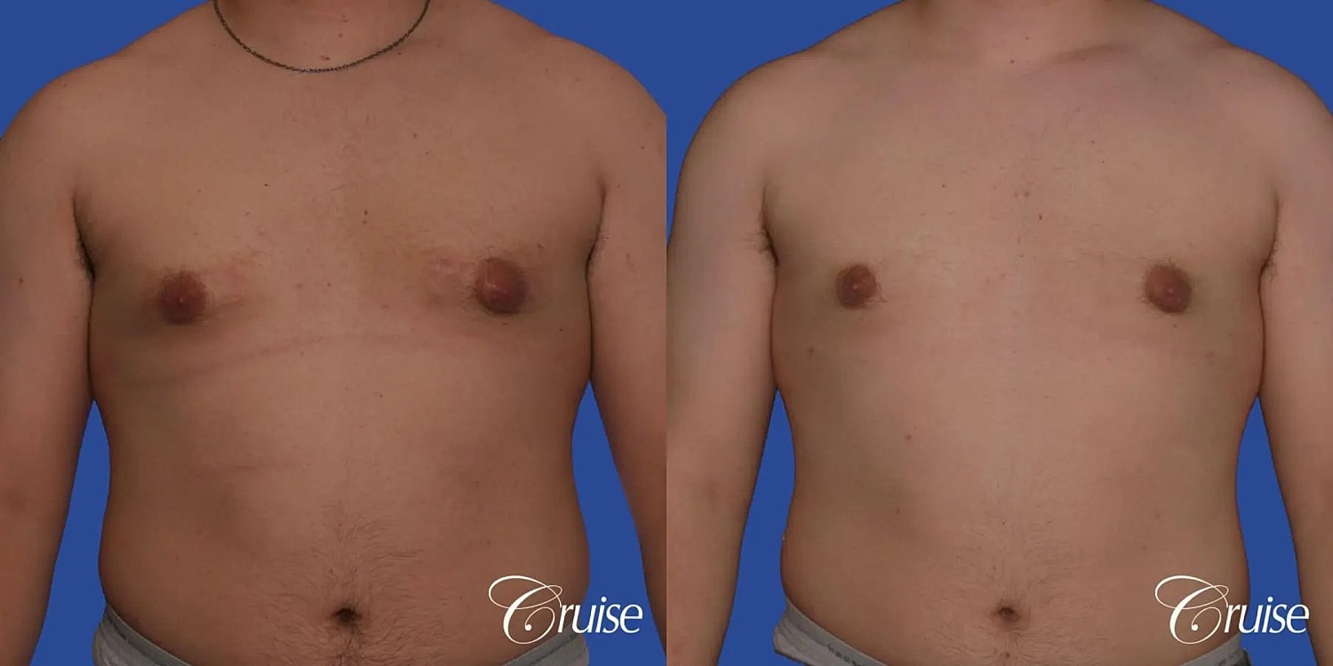 Gynecomastia Before & After