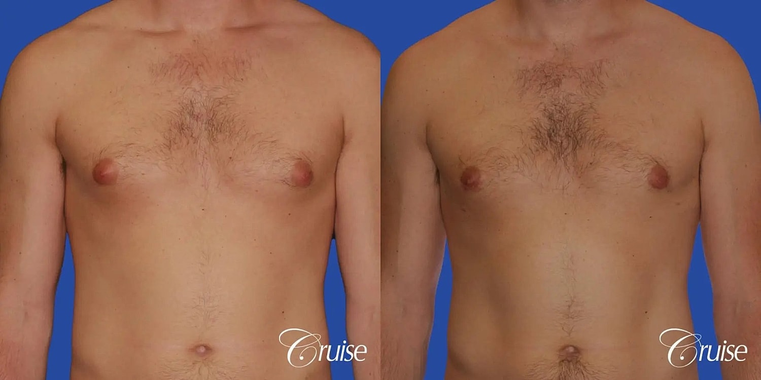 Gynecomastia Before & After