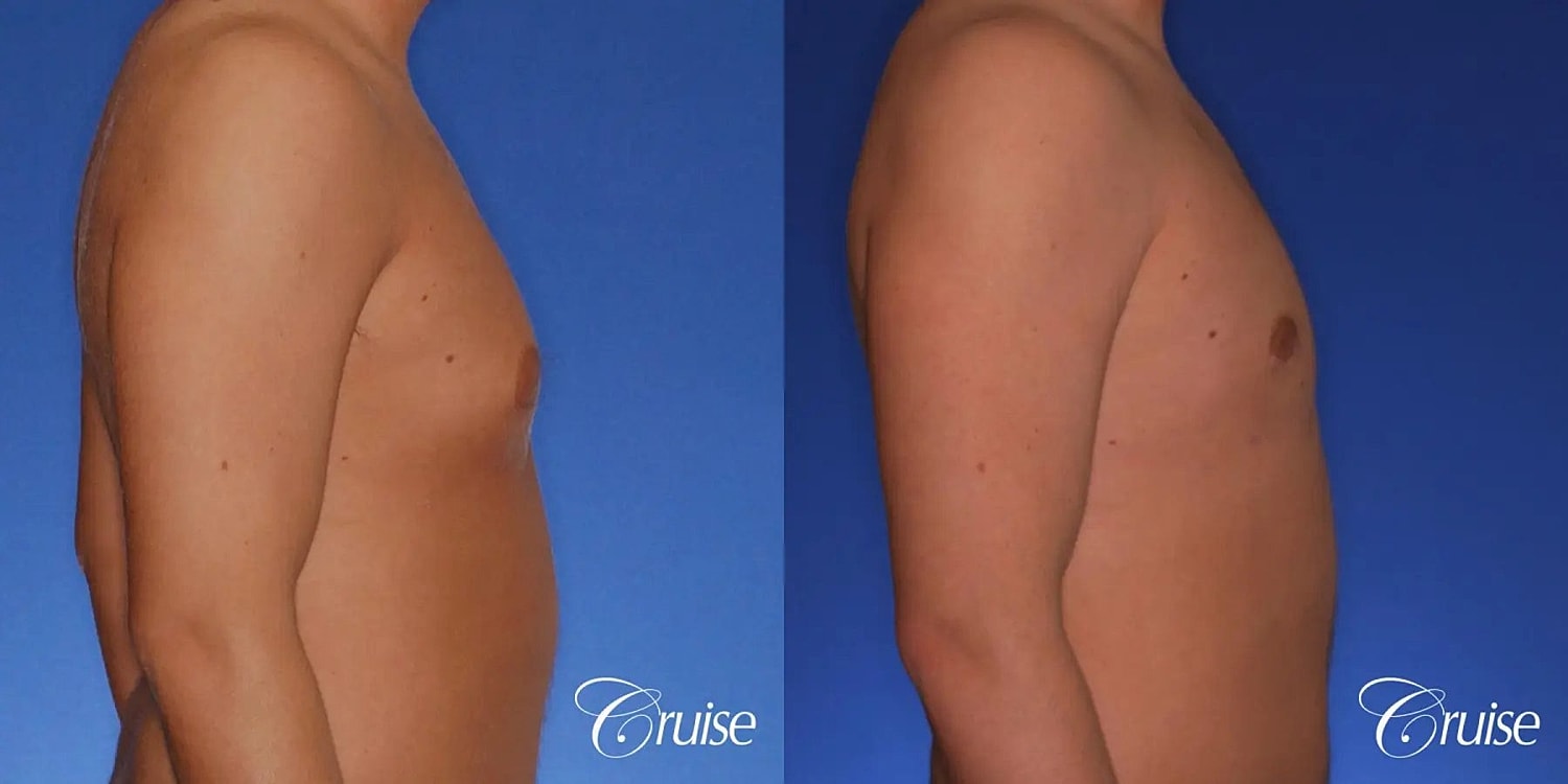 Gynecomastia Before & After