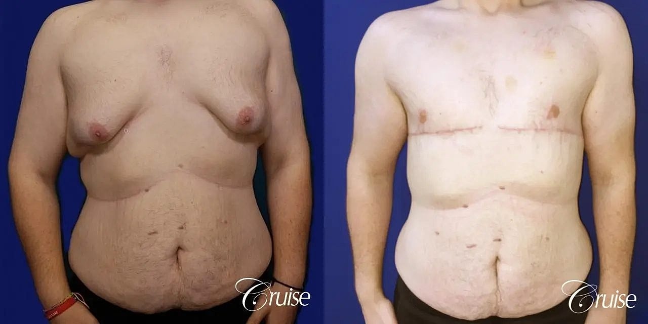 Gynecomastia Before & After