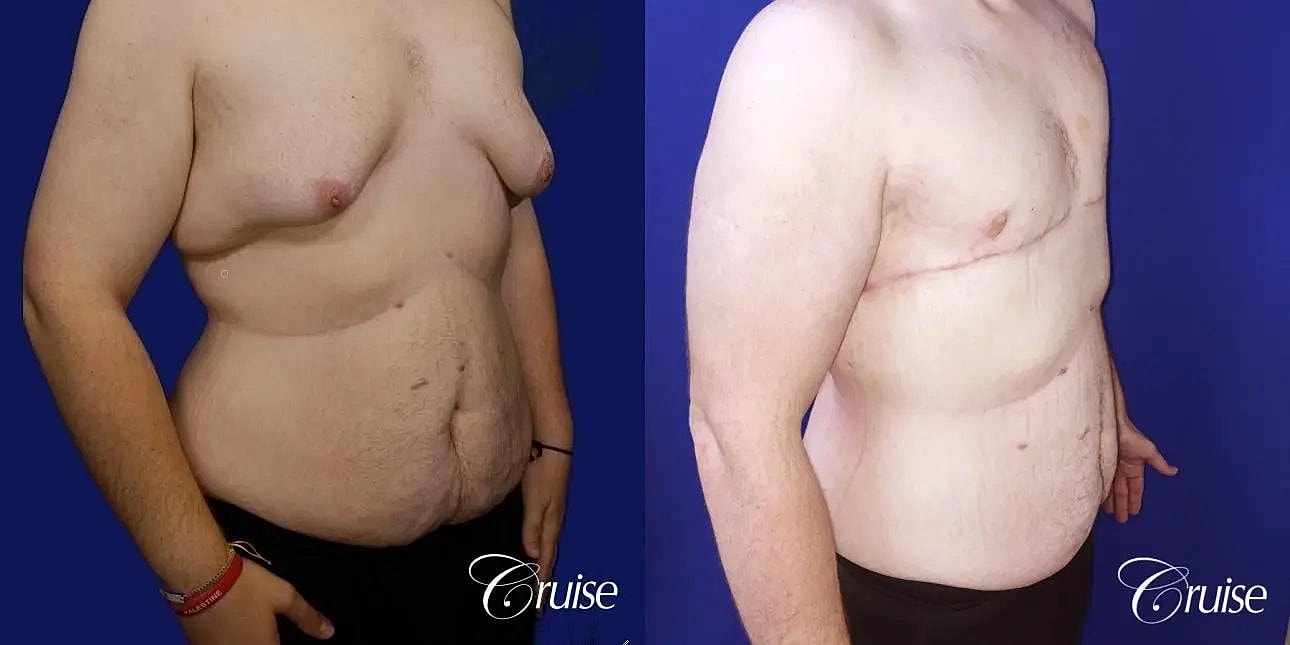 Gynecomastia Before & After