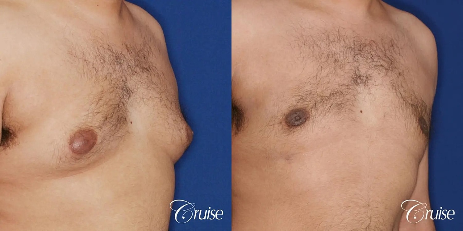 Gynecomastia Before & After