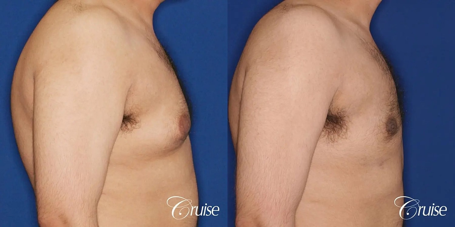 Gynecomastia Before & After