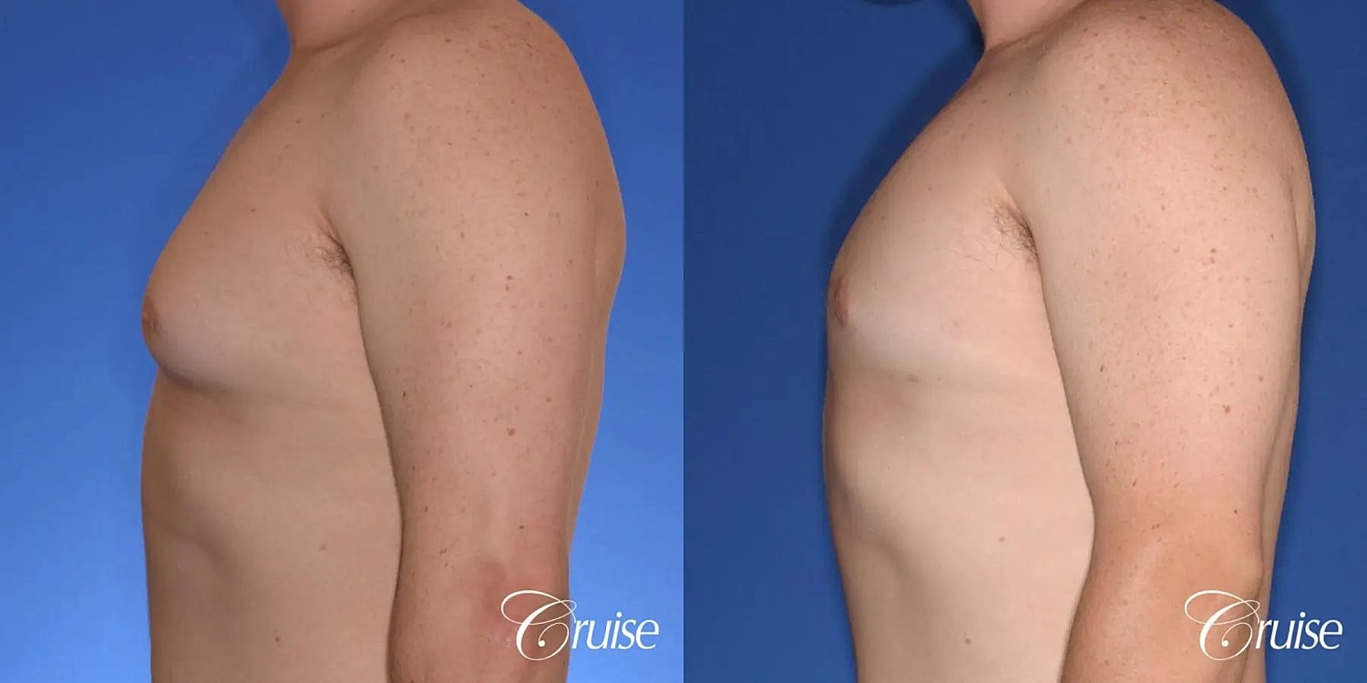 Gynecomastia Before & After