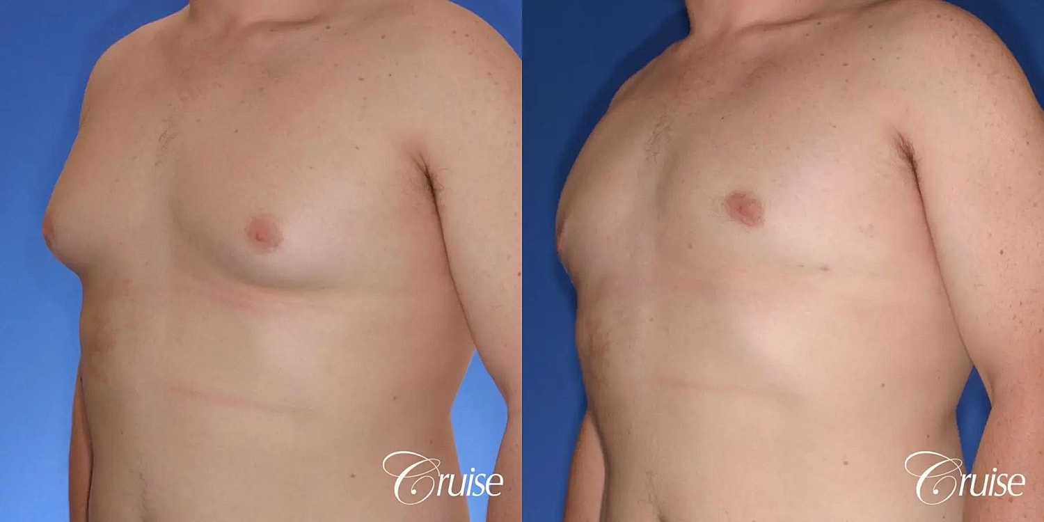 Gynecomastia Before & After