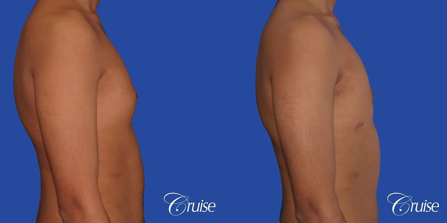 Gynecomastia Before & After