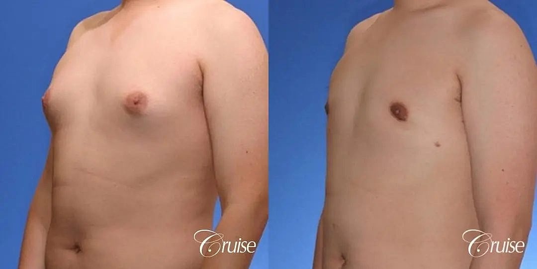 Gynecomastia Before & After
