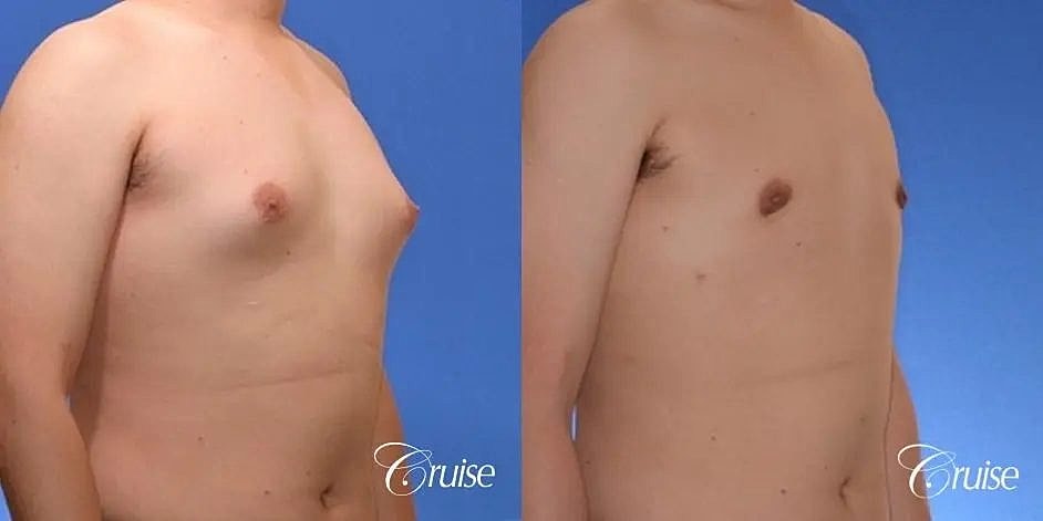 Gynecomastia Before & After