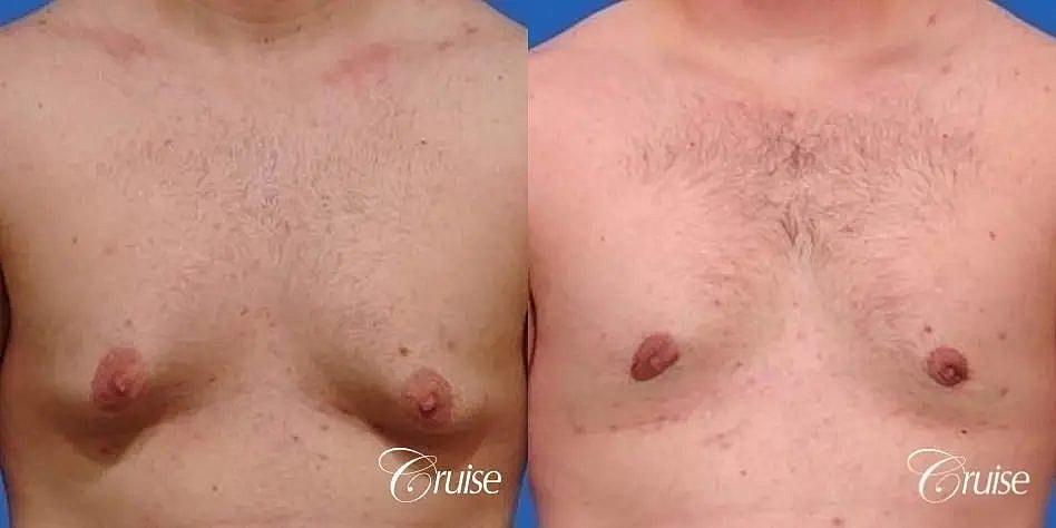 Gynecomastia Before & After