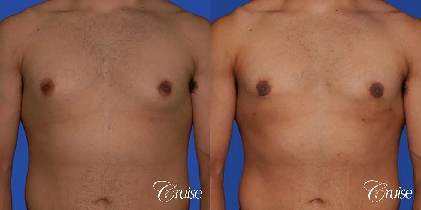 Gynecomastia Before & After