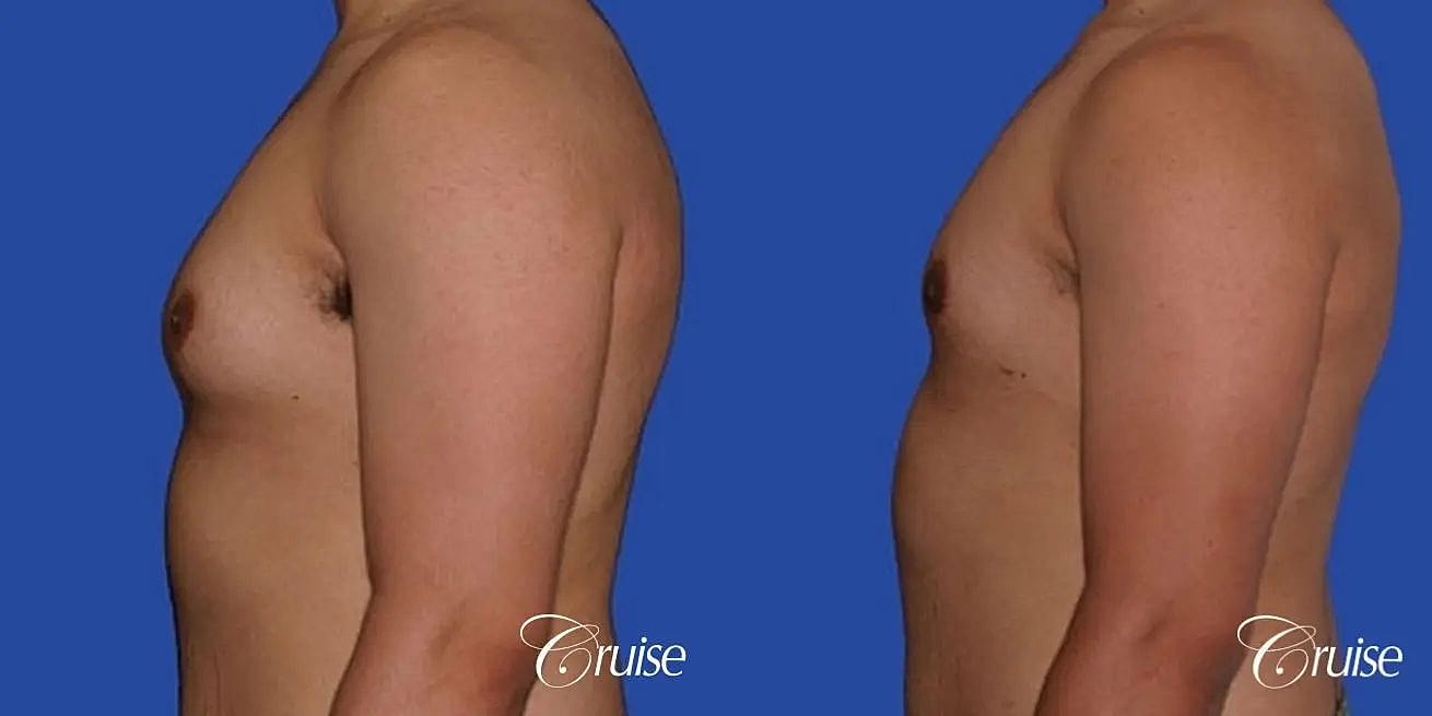 Gynecomastia Before & After