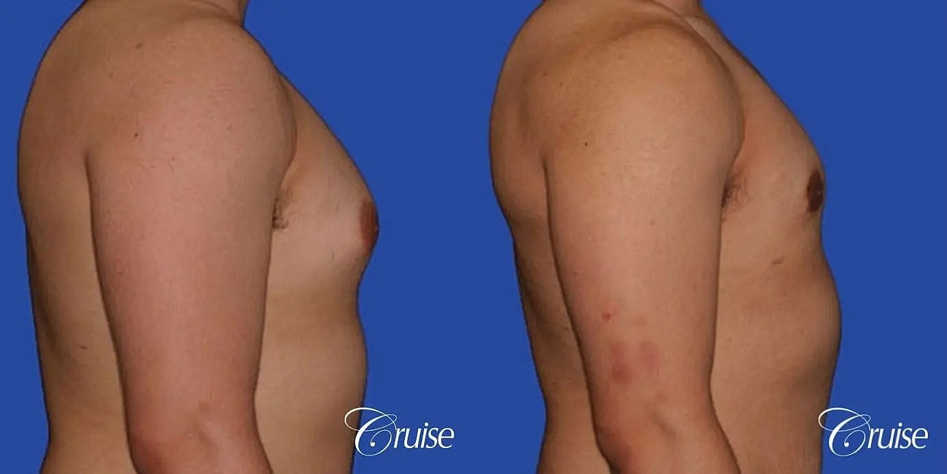 Gynecomastia Before & After