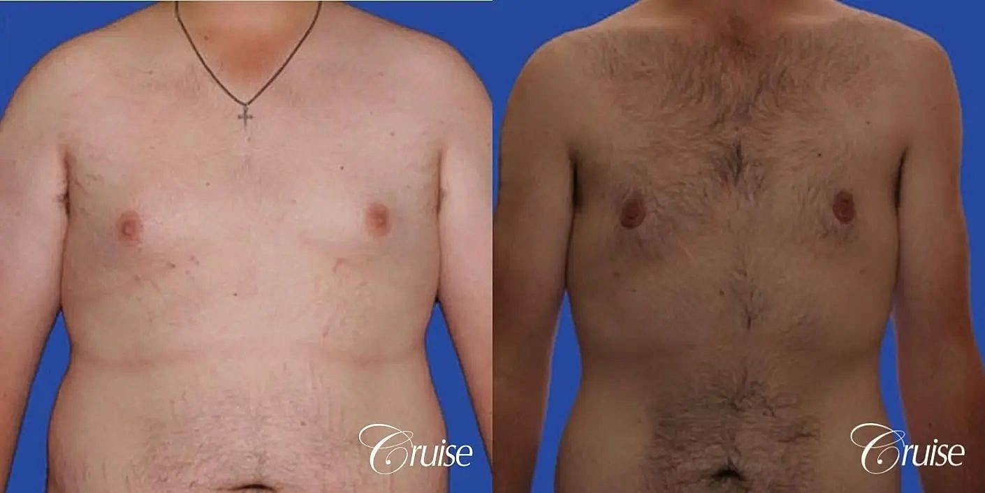 Gynecomastia Before & After