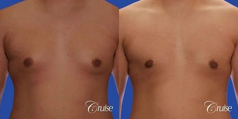 Gynecomastia Before & After