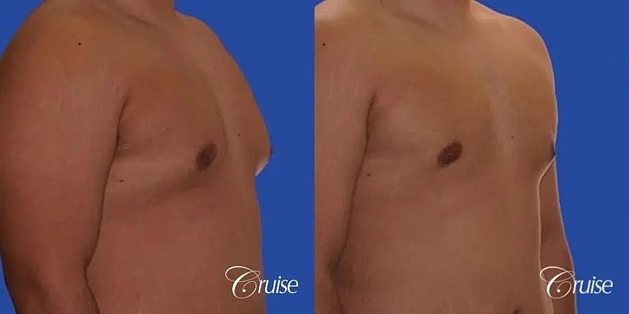 Gynecomastia Before & After