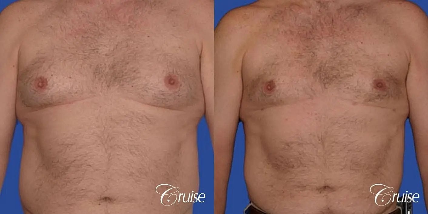 Gynecomastia Before & After