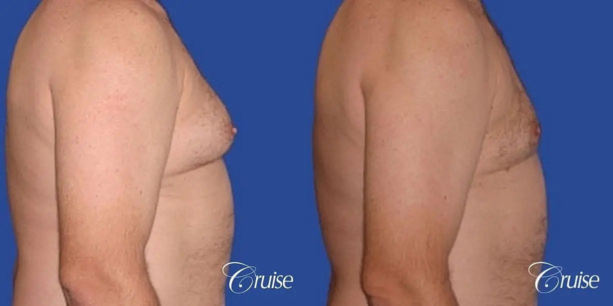 Gynecomastia Before & After