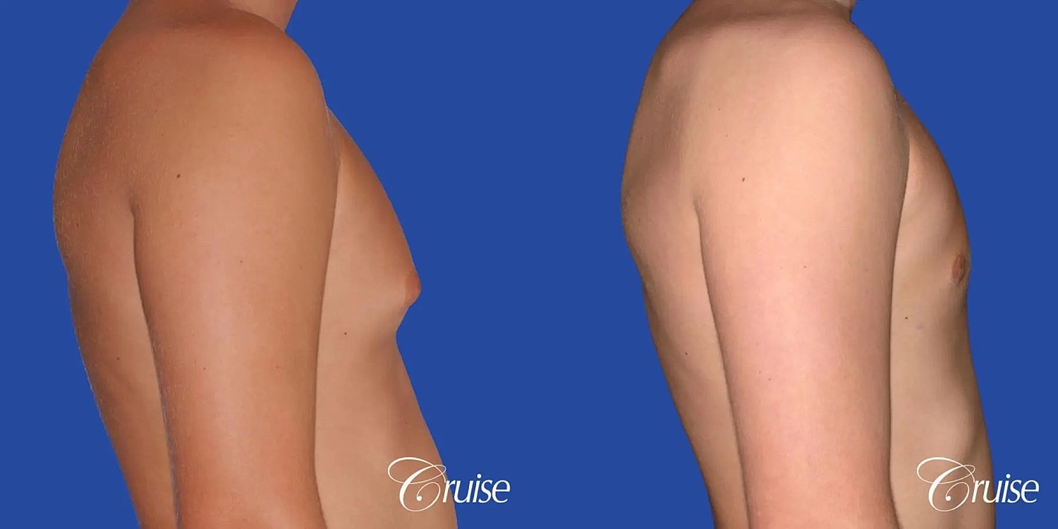 Gynecomastia Before & After