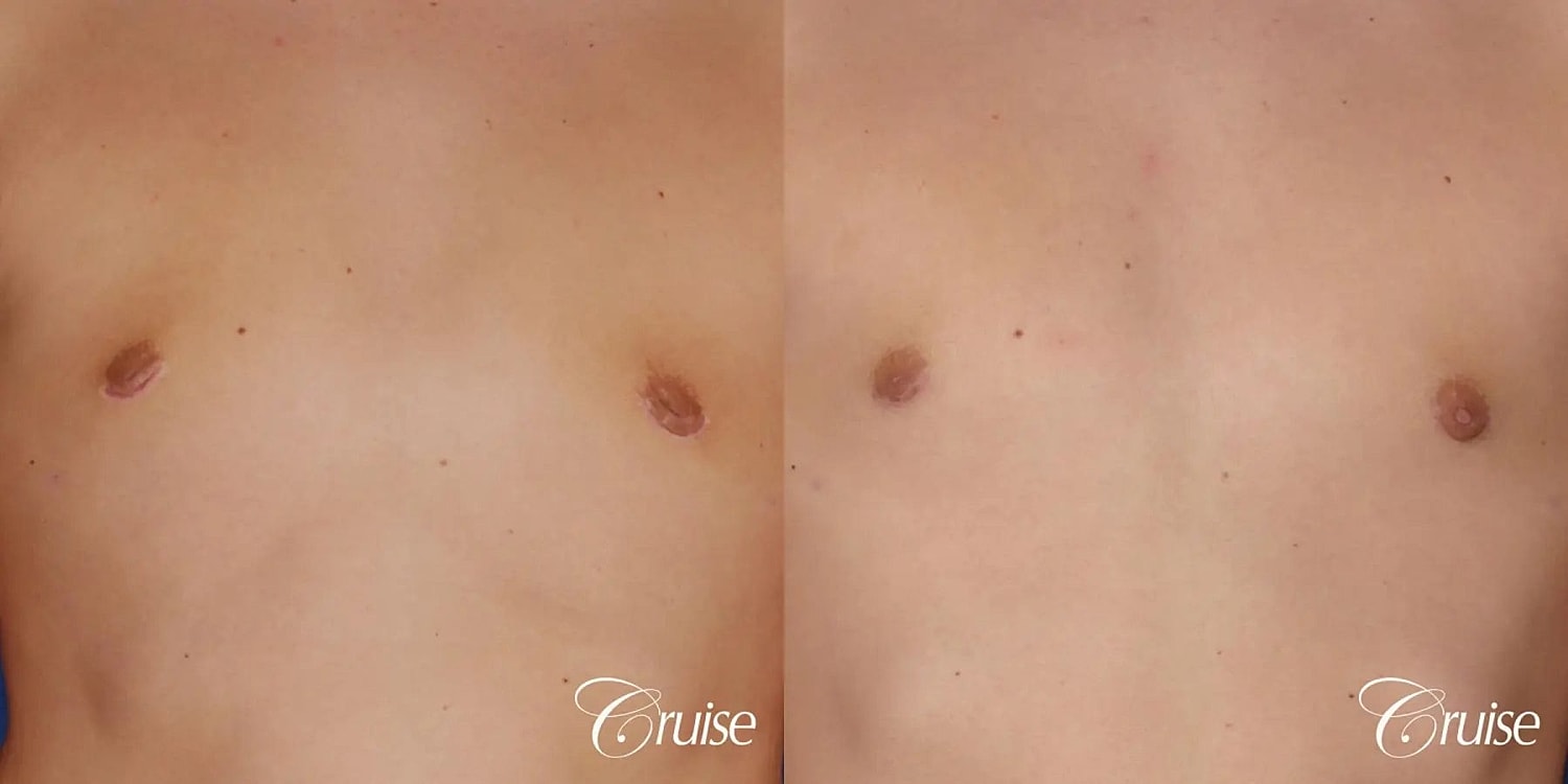 Gynecomastia Before & After