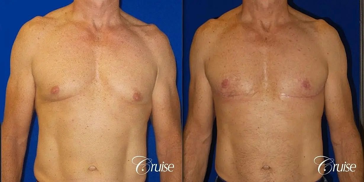Gynecomastia Before & After