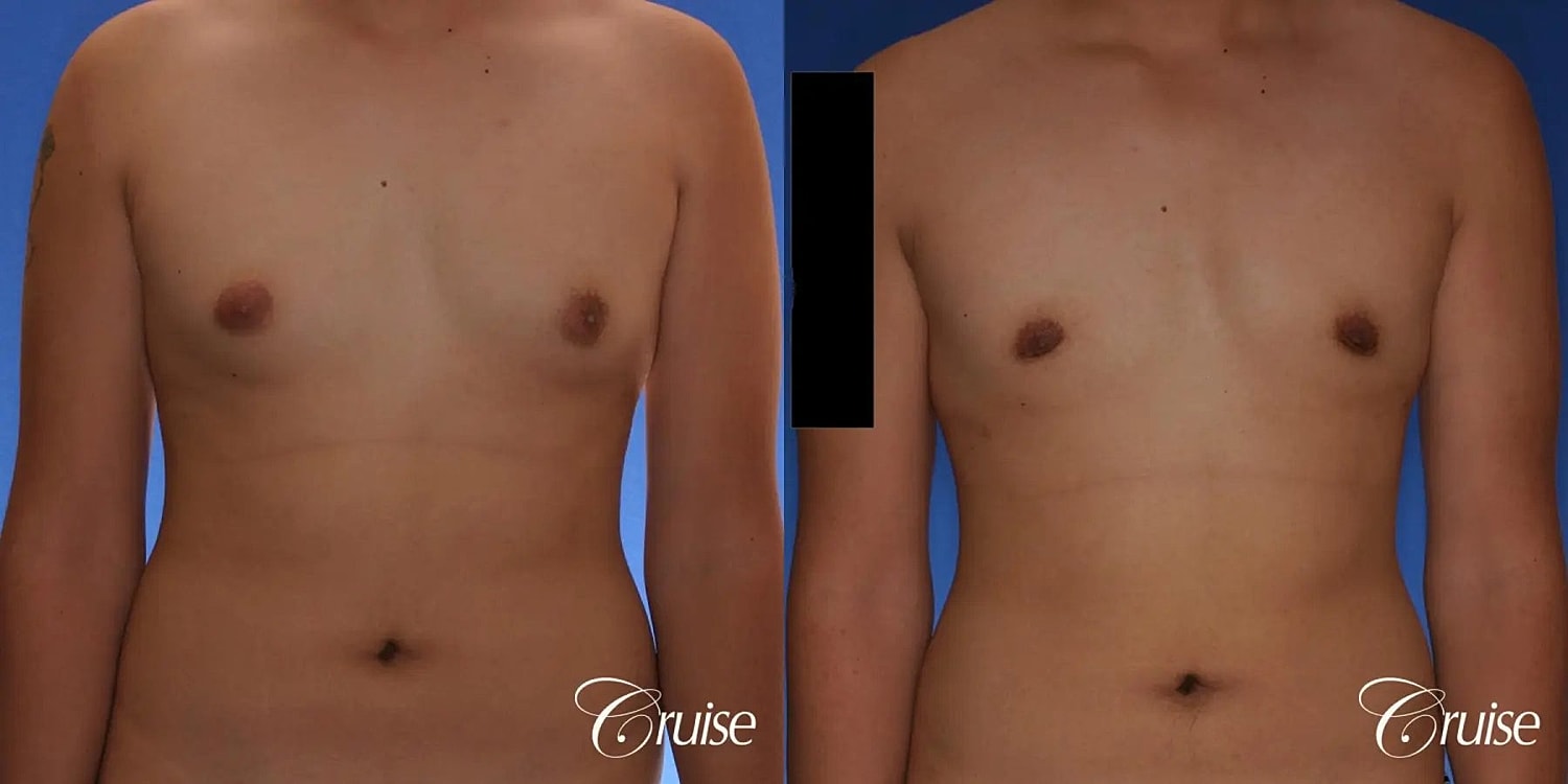 Gynecomastia Before & After