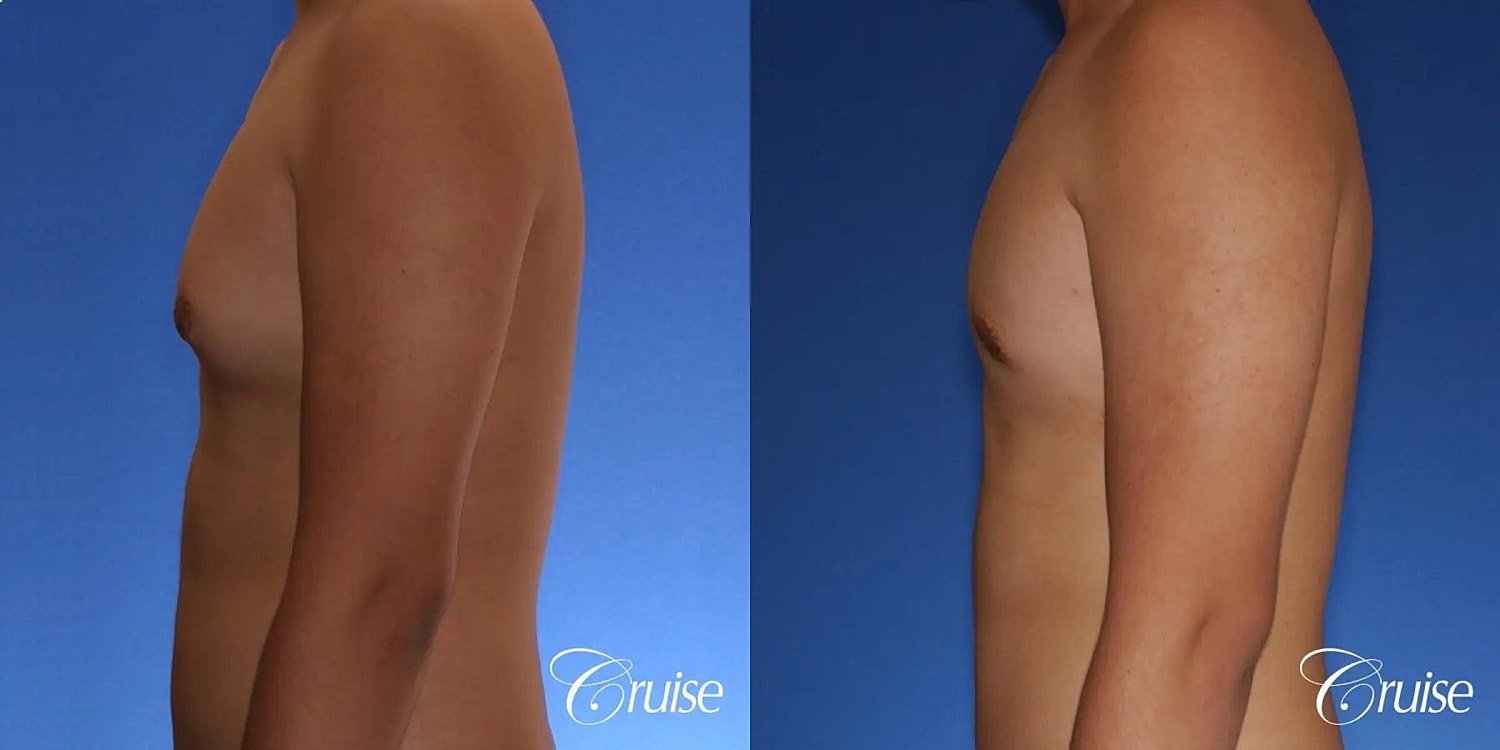 Gynecomastia Before & After