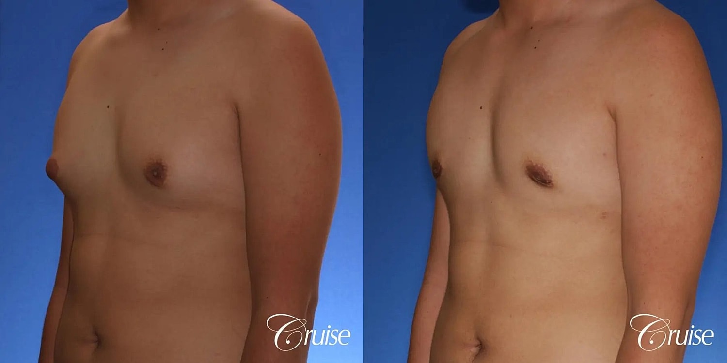 Gynecomastia Before & After