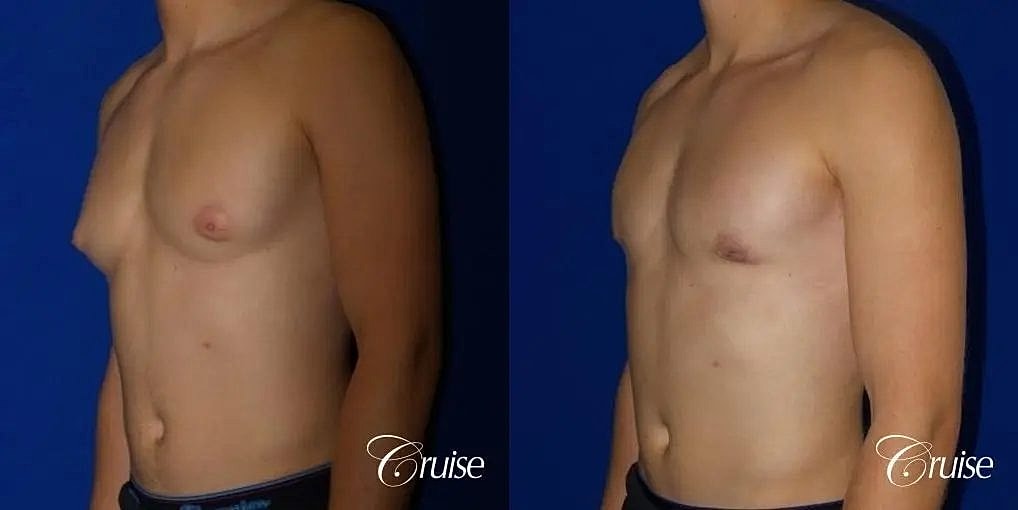 Gynecomastia Before & After